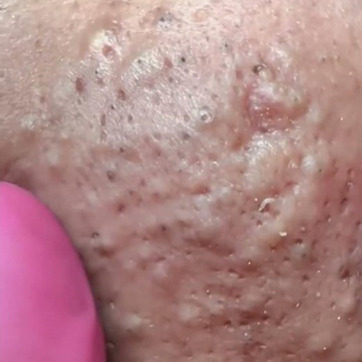 Pickel Ausdrücken Spa: Whiteheads Removal + Skincare ASMR #shorts