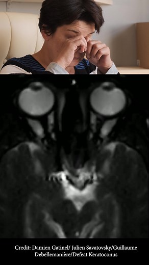 MRI of Eye Rubbing: Understanding the Effects