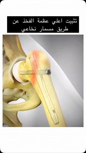 ‎𝐃𝐫.𝐒𝐡𝐨𝐛𝐚𝐤𝐲 |د.محمود الشبكي | اخصائي جراحة عظام‎ on Instagram‎: "تثبيت كسور أعلى مفصل الفخذ بالمسمار النخاعي (PFN) يُعتبر المسمار النخاعي Proximal Femoral Nail (PFN) من أكثر الطرق فعالية لعلاج كسور أعلى عظمة الفخذ، خاصةً تلك التي تصيب منطقة المدورين أو أسفلها. يُستخدم هذا النوع من التثبيت الداخلي لعلاج الكسور غير المستقرة والمفتتة، مما يساعد في استعادة وظيفة الطرف السفلي بسرعة وتقليل المضاعفات الناتجة عن العلاج التقليدي. آلية العمل والتطبيق •تصميم المسمار: يتكون PFN من مسمار طويل يتم إد