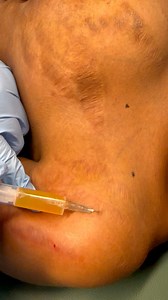 PRP Micro-Needling is a proven method to help reduce the appearance of unsightly stretch marks… This induces the release of growth factors into the connective tissue space. Collagen is produced over a period of time. “PRP is a great, non-invasive treatment for stretch marks because it helps generate the production of new collagen and elastin.platelet rich plasma treatments provide effective relief from stretch marks, sagging skin, scars, skin discolouration, ..#skin #stretchmarks #skincareroutin