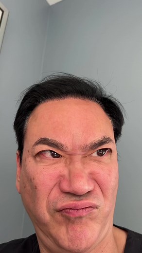 Upper Lip Lift Plastic Surgery by Dr. Lee 90210