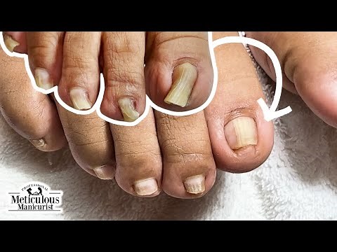 Incredible Pincer Toenail Makeover: A Transformation