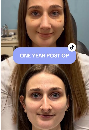 I prepared for my nose job the same way I prepare for nothing else in life: obsessively and emotionally 😭 Thank you so much @Dr Mark Ginsburg 👃🏼 #nosejob #rhinoplasty #drmarkginsburg #glenmills #plasticsurgery