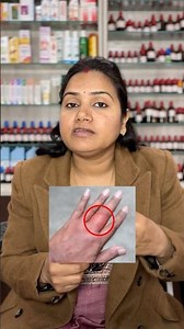 Chilblains : सर्दी में सूज जाते हैं हाथ पैर | Swollen hands and fingers in Winter