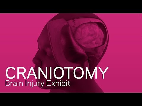 Craniotomy - Traumatic Brain Injury Animation