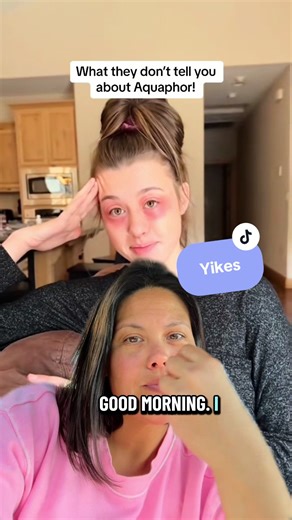 Understanding Allergic Reactions to Lanolin