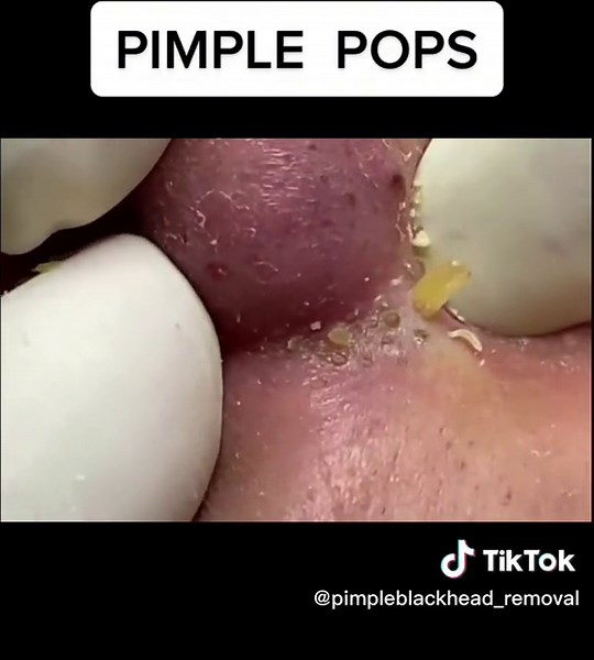 #acne #antiaging #acnetreatment #blackheadremoval #blackhead #blackheads #blackheadextraction #facialathome #cyst #clearskin #dermaplaning#drpimplepopper #dermaplane #drsandralee#glowingskin #oilyskin #pimple #pimplepopper#pimpleproblems #pimplepopping #pimplepoppers #skincare #naturalskin #sivilcesikma #zits #skinhealth #skincaretips