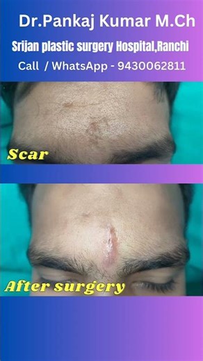 scar revision surgery in Ranchi| Best scar treatment in India #shorts #Scar