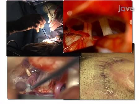 Microvascular Decompression: Salient Surgical Principles and Technical Nuances