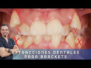 ¿EXTRACCIONES DENTALES para poner BRACKETS SON NECESARIAS?