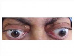 Causes of Bilateral Exophthalmos || Bilateral Proprtosis || Bulging Eyes