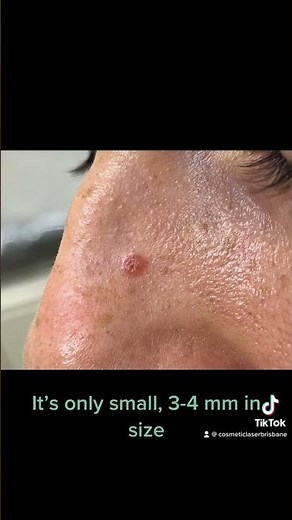Basal Cell Carcinoma (non melanotic skin cancers) on the nose
