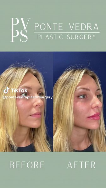 Loved this before and after of a natural transformation using JUVEDERM® Ultra XC ! Intended for US audiences only. For important safety information see @Juvederm Results may vary. #juvedermcoopprogram