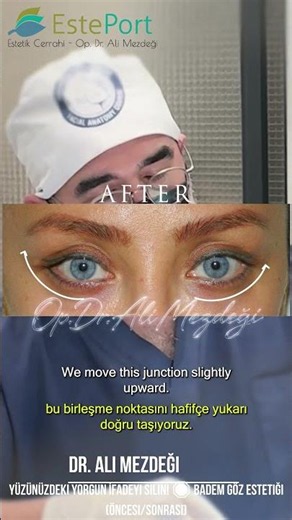 Erase That Tired Look From Your Face! 🛑 Almond Eye Aesthetics (Before&After)