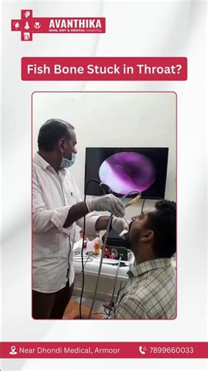 Safe Fish Bone Removal by Dr. D. M. Bhavankumar | ENT Specialist in Armoor | Avanthika Hospital