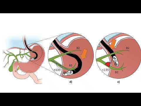 EUS-guided hepaticogastrostomy: practical tips and tricks