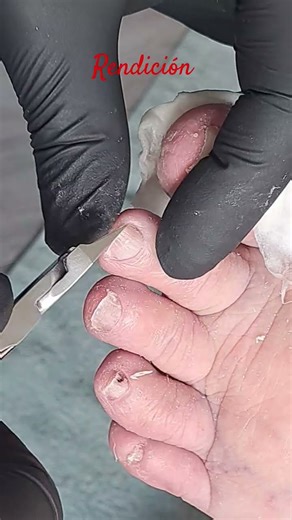 Paciente tercera edad. Heloma doloroso plantar. Consultas cada 9 semanas. Sencilla, amable, amistad