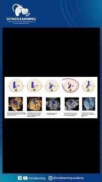 Mastering the 3VT Cut in the First Trimester: Patterns of Suspicion for Heart Disease