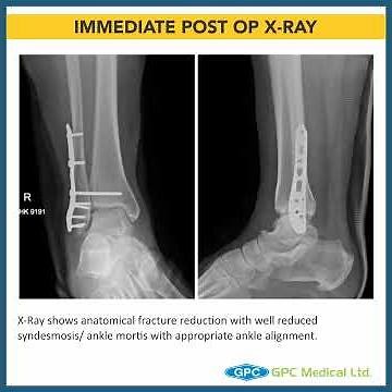 Ankle Fracture Series: Management Technique for Lateral Malleolar Fractures | GAITS Academy