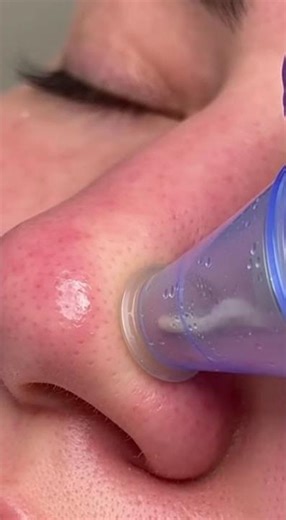 Best Pore Vacuum Blackhead Remover Tool 2025 | Deep Cleansing Skincare Review