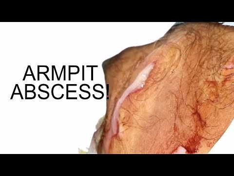 Armpit Abscesses! Axillary Abscess Treatment and Drainage