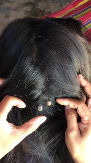 Oh my god #losangeles #ticks #liceremoval #foryou #fyp