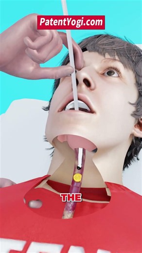 A Coin Got Stuck in the Throat