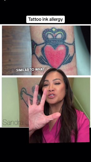 A tattoo reaction to, yes you guys guessed right, RED ink which is rhe most common color people react to #drpimplepopper #tattoo #tattooreaction