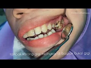 Dental Calculus Removal With Original Sound Of Scaler