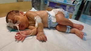 From NG Tube to Oral Feeding – Baby s Big Step Towards Recovery 👶💪 | NICU Journey#NGFeeding#nicubaby #cutebaby #babybirth #baby #babycare #babycaretips #newbornhygiene #newborncare #cute This video shows the journey of a newborn baby transitioning from NG (Nasogastric) tube feeding to oral feeding. It’s a critical and emotional milestone in NICU care. Many premature or medically fragile babies start feeding through an NG tube due to their inability to suck, swallow, or coordinate breathing. As