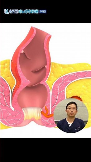 호기심에 항문으로 성교 하다간.. 애널성관계의 위험성!