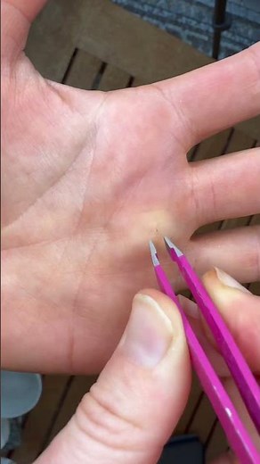 How to get a splinter out when tweezers don’t work #carpentry #diy #splinter #hack