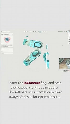 You can now do All-on-X cases with dedicated workflows in TRIOS 25.3 software update. #3shape