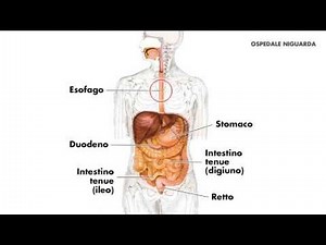 Ligation of esophageal varices