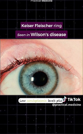 Identifying Wilson's Disease Through Choreiform Movements