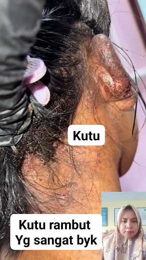 744K views · 2.9K reactions | Kutu Rambut #fyp #viral #kuturambut #reelsfb #trendingreels | Nurhasna Muhamad Ipa | Facebook