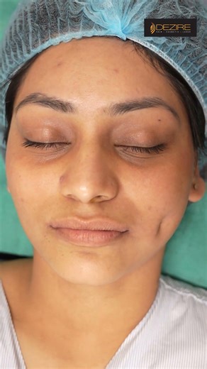 One side Dimple Creation