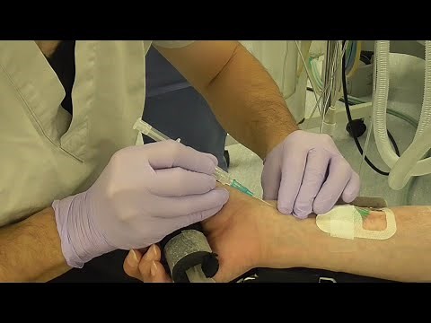 【ライン】動脈穿刺(Aライン)_インサイト-Aを用いたSeldinger法