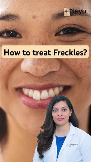 How to treat Freckles on Face | Freckles removal #frecklesface #freckles