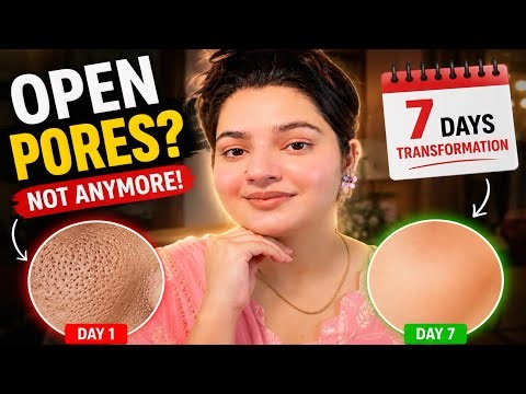 7 Days Open Pores Treatment: Blackheads, Enlarged Pores & Acne Treatment at Home |