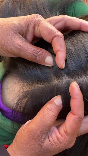 Efectiva Remoción de Piojos: Consejos y Trucos