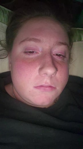 Recovering After Wisdom Tooth Removal Made Easy