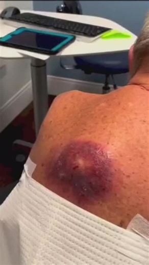 #pimples #pimplesolution #pimplepop #pimplepopping #bestpimplevideos #giganticpimple #satisfying #cyst #boil #compilation #skincare #infected