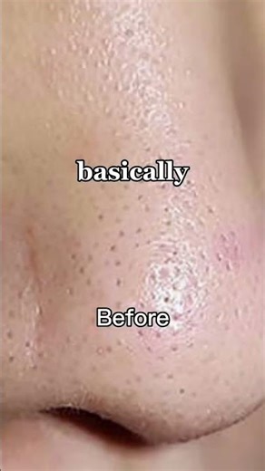 Ultrasonic Skin Cleaner On Acne Pron Skin | Ultrasonic Scrubber Black Head Extractions On Chin |