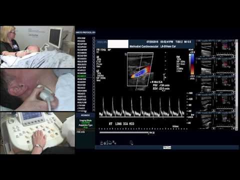 Carotid Protocol (Esther Collado, RN, RVI)