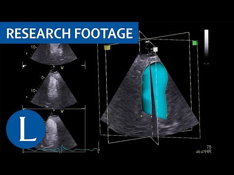 Contrast 3D echocardiography to quantify left ventricular volumes and ejection fraction