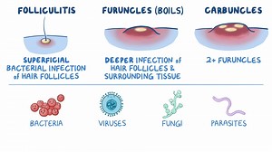 Video: Folliculitis, carbuncles, and furuncles: Nursing - Video Explanation! | Osmosis | Osmosis