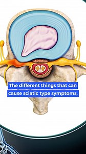 Causes for sciatica and the SECRET about the SOLUTION ✨ Multiple things can cause the symptoms of sciatica ⚡️, like a herniated disc, a bulging disc, stenosis, facet pain, facet joint syndrome, bony growth, and soft tissues or other muscular tissues that are inflamed and pressing on a nerve. 😣 These can all lead to sciatica in your hips, legs, thighs and feet. The secret 🕵️‍♂️ about the solution is to create MORE SUPPORT for your spine. ⚓️ YES for all those causes, the solution is the same! I 
