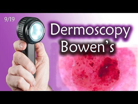 Master Bowen's disease with 4 simple steps