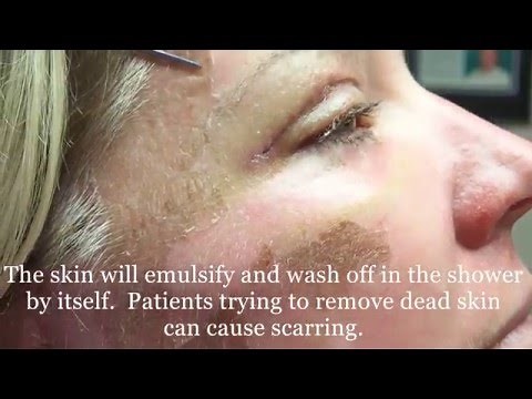 Peeling Skin from 30% TCA peel
